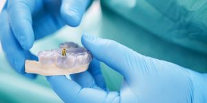 Dentist holding teeth model with metal dental implant