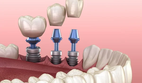 İmplant Tedavisinde Kemik Yapısı Neden Önemlidir?