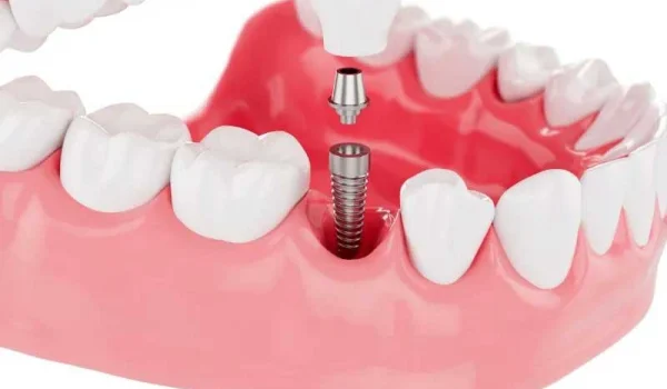 İmplant Tedavisi Fiyatları Neye Göre Değişir?