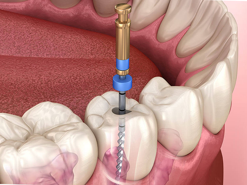 Keçiören Endodonti